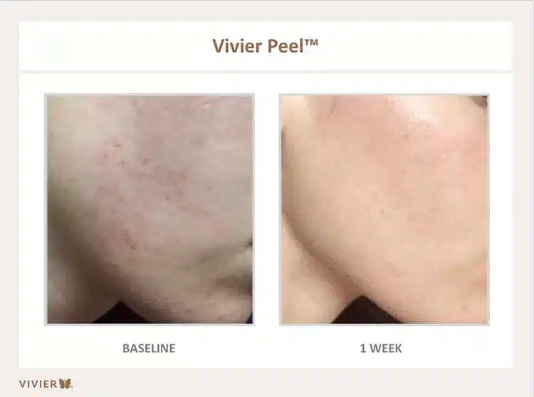 CHEMICAL PEELS chemical-peel-facial