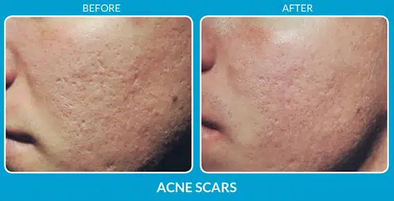 before-and-after-acne-scars