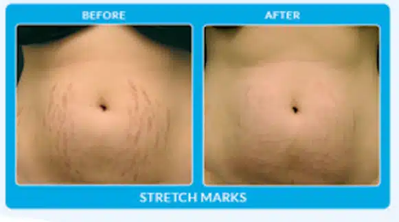 before-and-after-stretch-marks