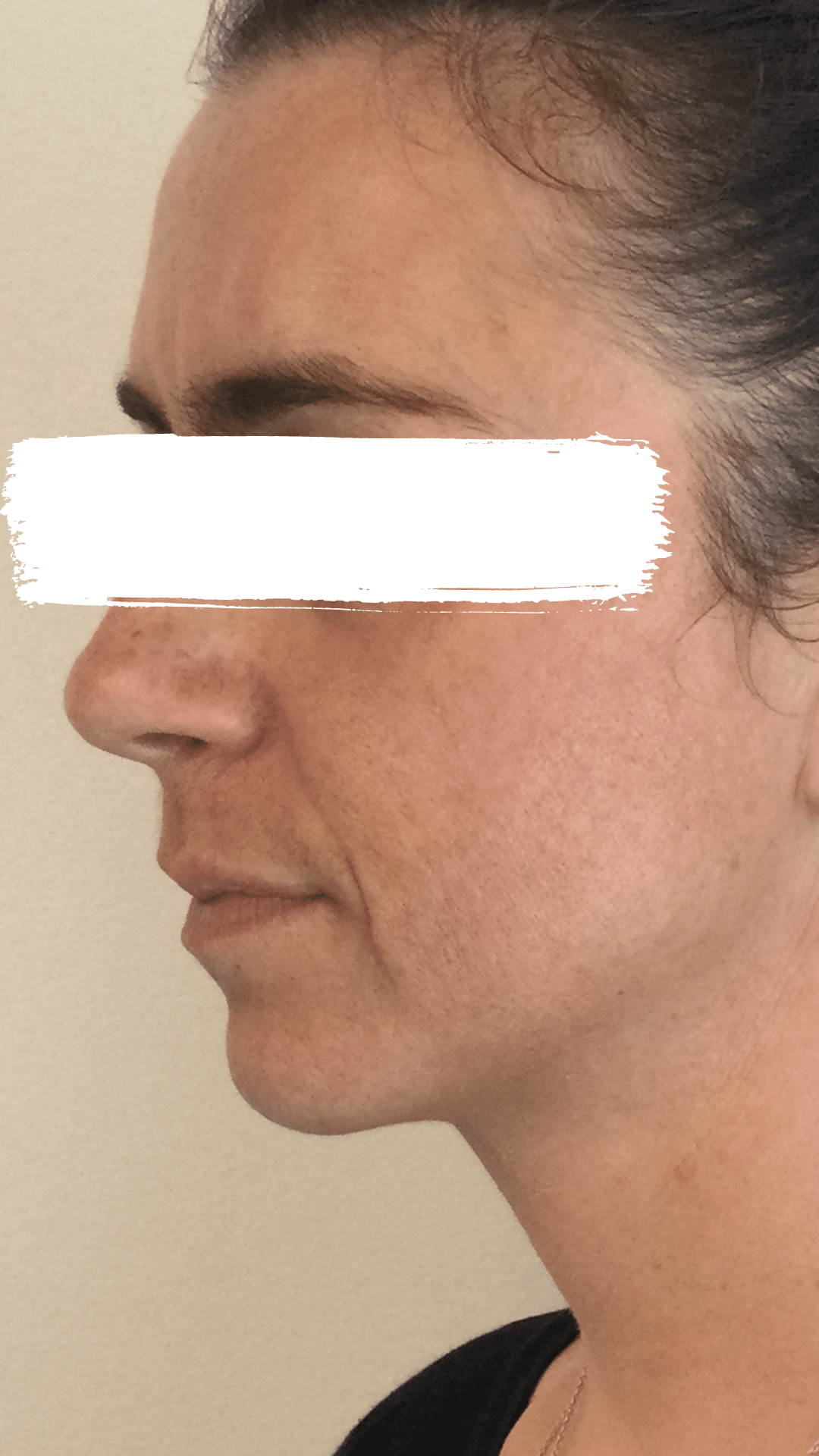 after-dermal-fillers-oakville-ontario