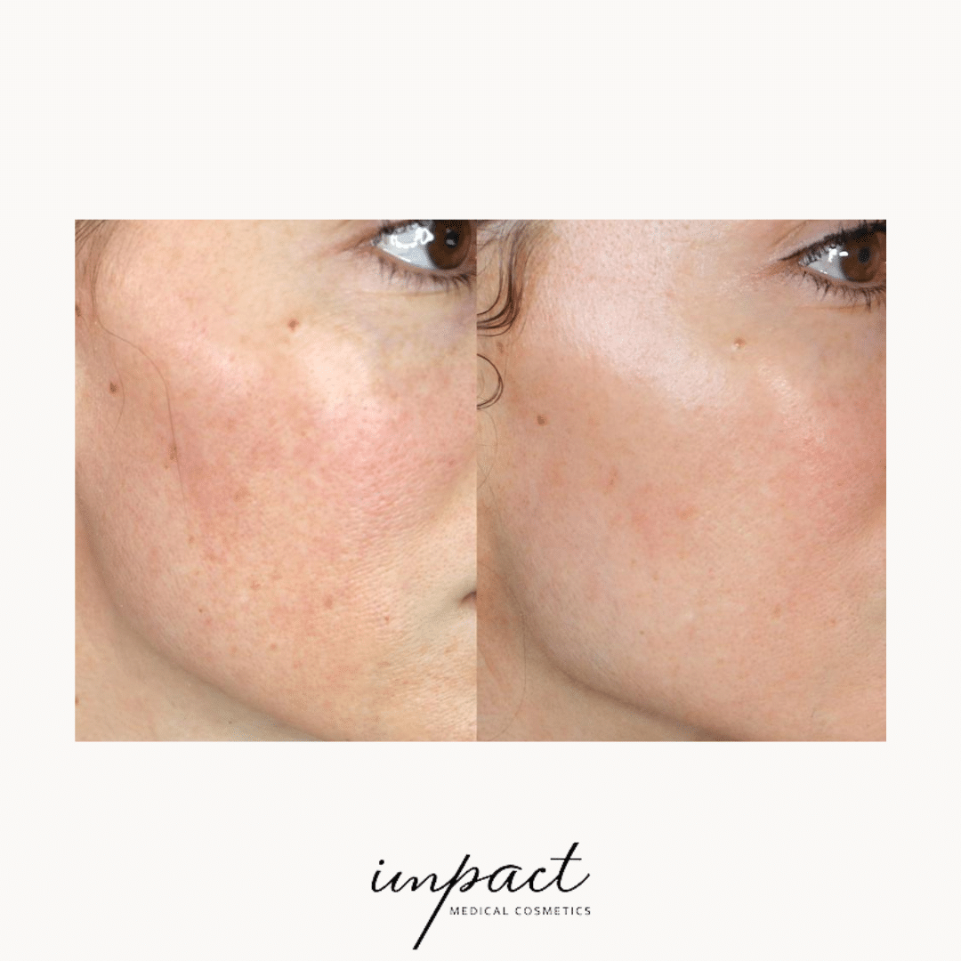 MICRONEEDLING Impact Cosmetics Oakville BOTOX Clinic Dermal Fillers Laser Hair Removal