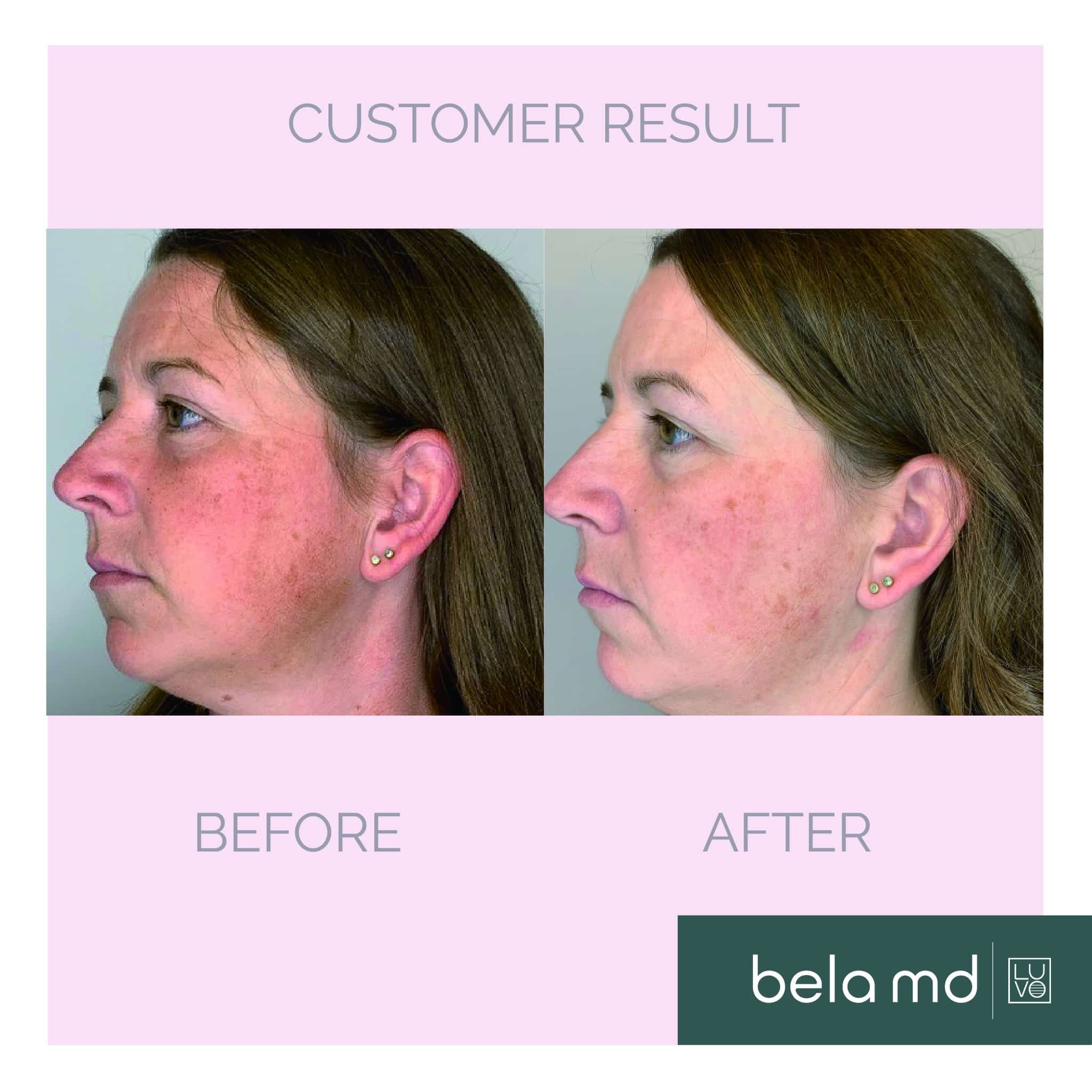 Hydrafacial Impact Cosmetics Oakville BOTOX Clinic Dermal Fillers Laser Hair Removal