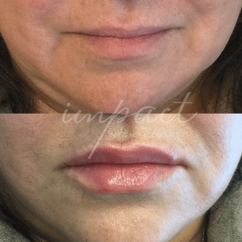 before-and-after-dermal-fillers-oakville-ontario