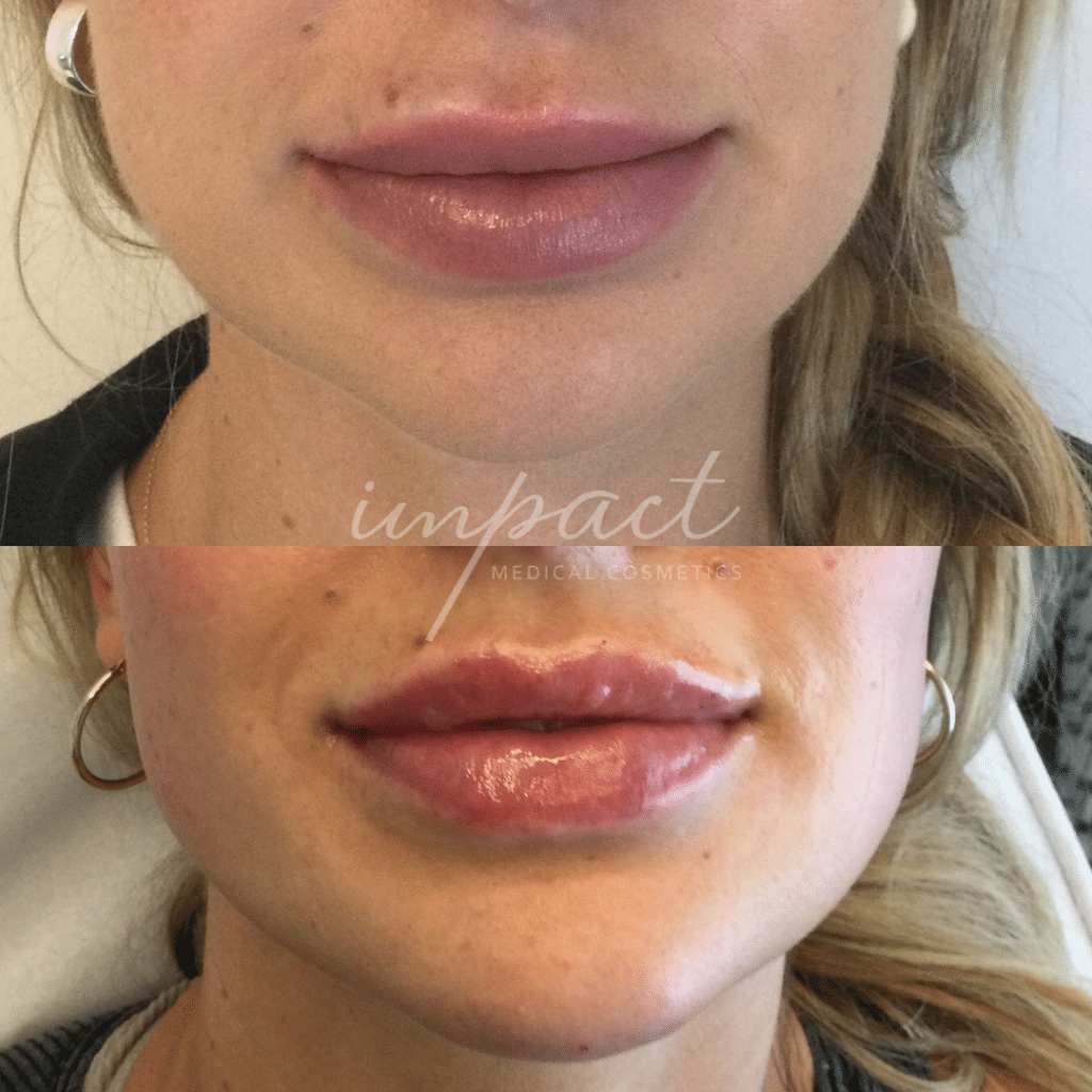 dermal-filler-before-and-after-impact-cosmetic